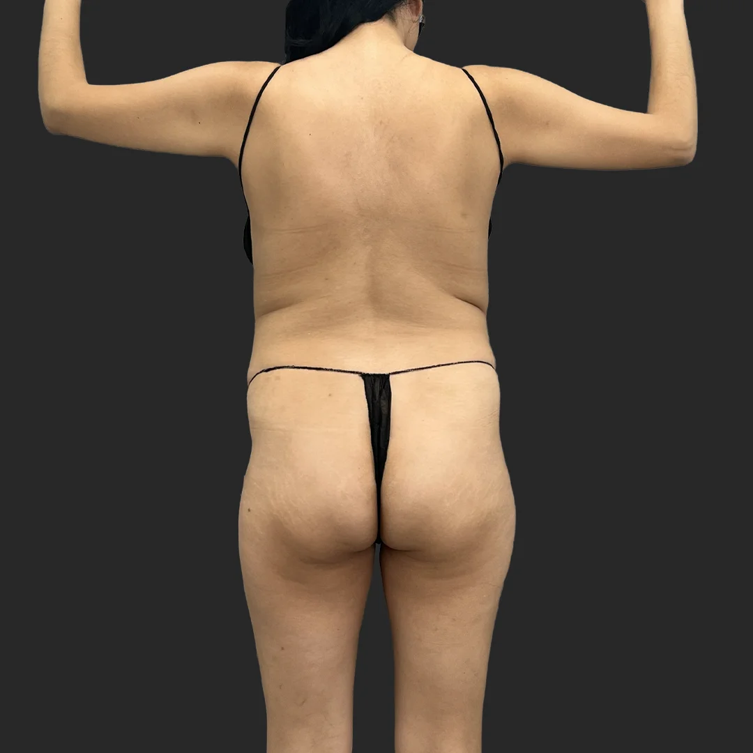 Bbl result at Be That Beautiful™ Plastic Surgery