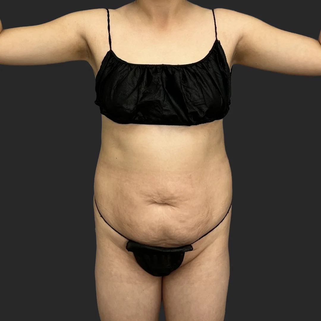 Tummy Tuck result at Be That Beautiful™ Plastic Surgery
