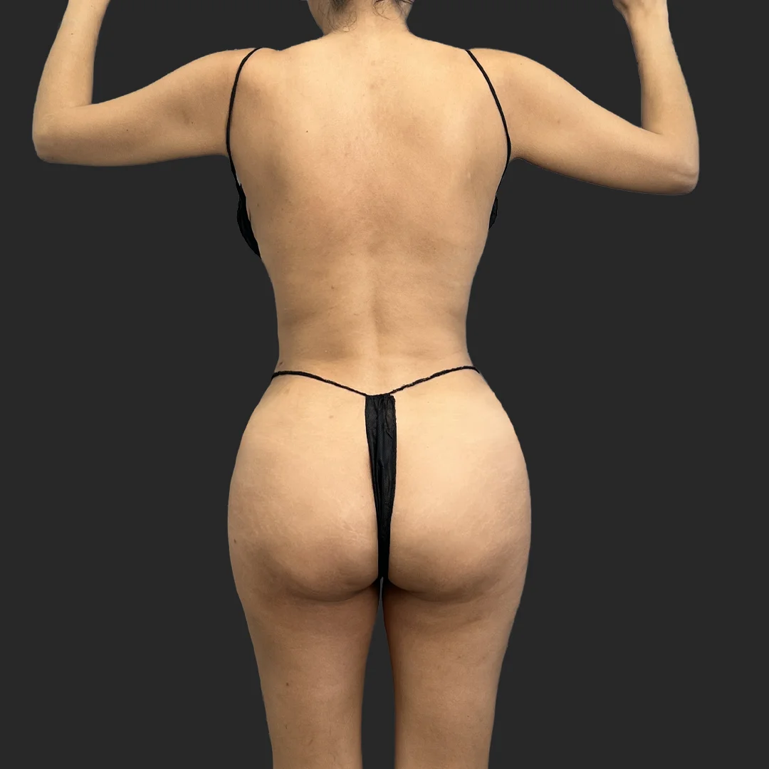 Bbl result at Be That Beautiful™ Plastic Surgery
