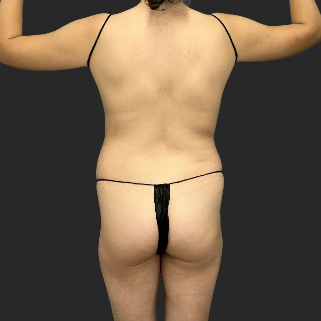 Tummy Tuck result at Be That Beautiful™ Plastic Surgery