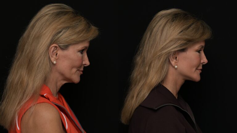 A result from Revel You Facial Plastic Surgery