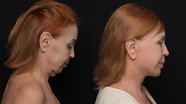 A result from Revel You Facial Plastic Surgery