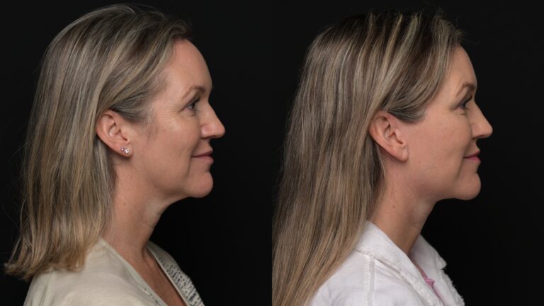 A result from Revel You Facial Plastic Surgery