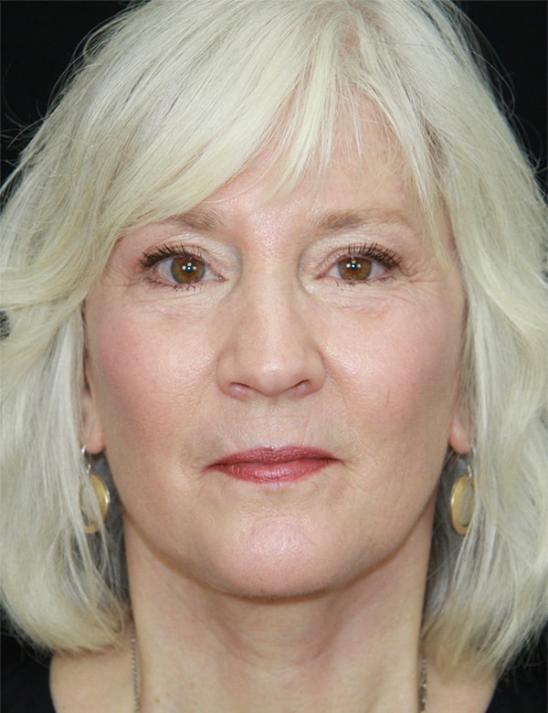 A result from Palm Beach Facial Plastic Surgery