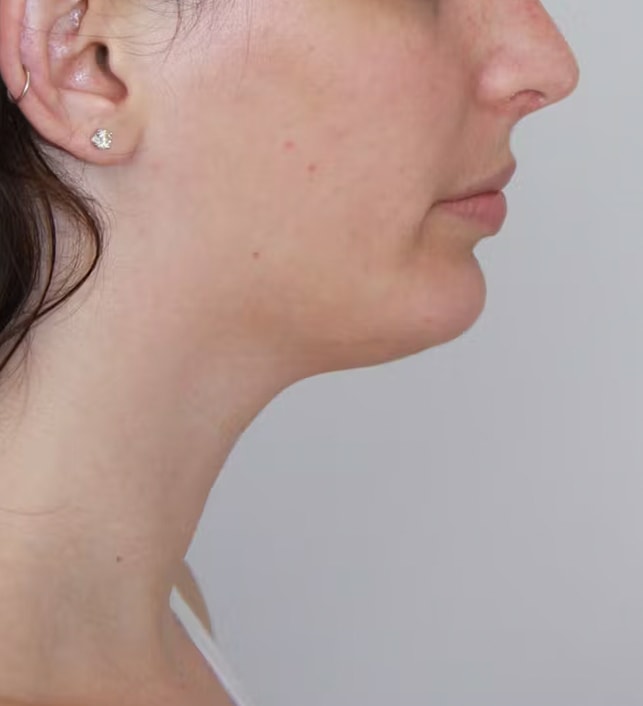 A result from Palm Beach Facial Plastic Surgery