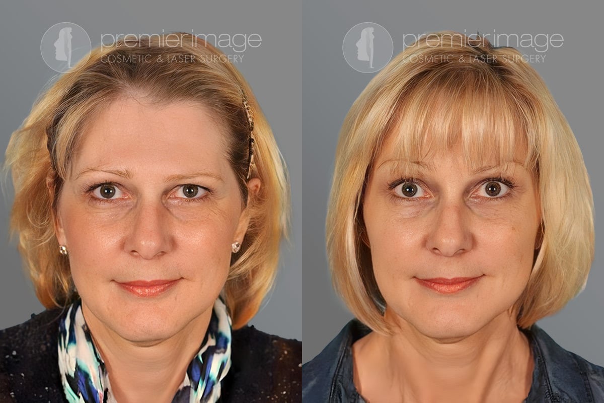 A result from Premier Image Cosmetic & Laser Surgery