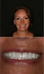 Rod Gleave DMD dental veneers result