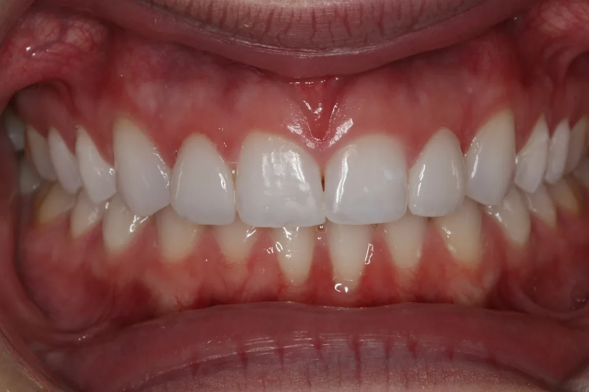 A result from Rod Gleave DMD