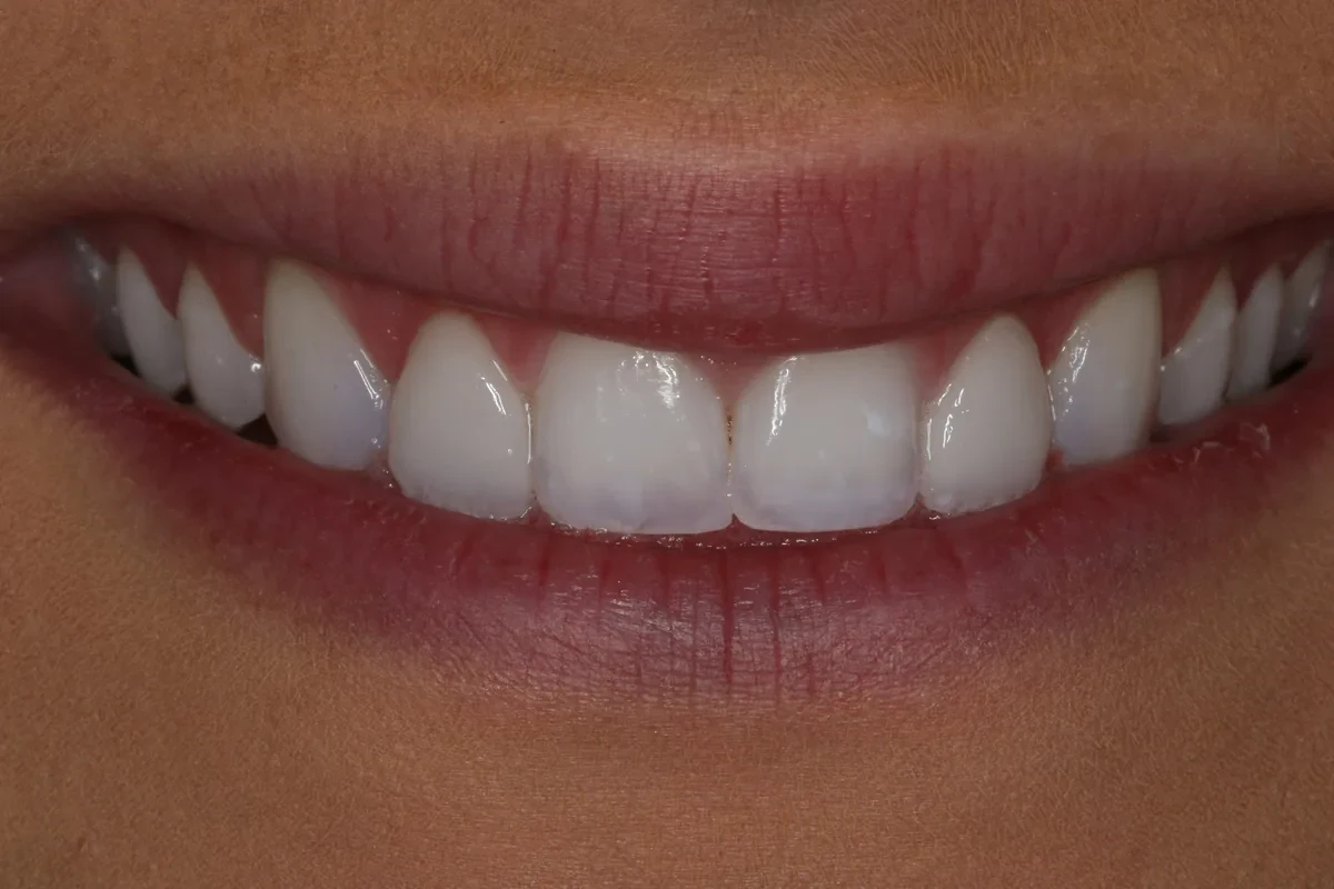 A result from Rod Gleave DMD