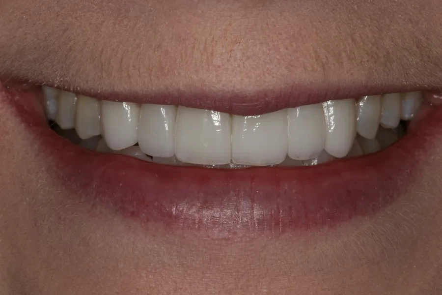 A result from Rod Gleave DMD