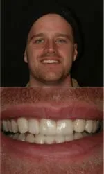 Rod Gleave DMD veneers after — Salt Lake City, UT