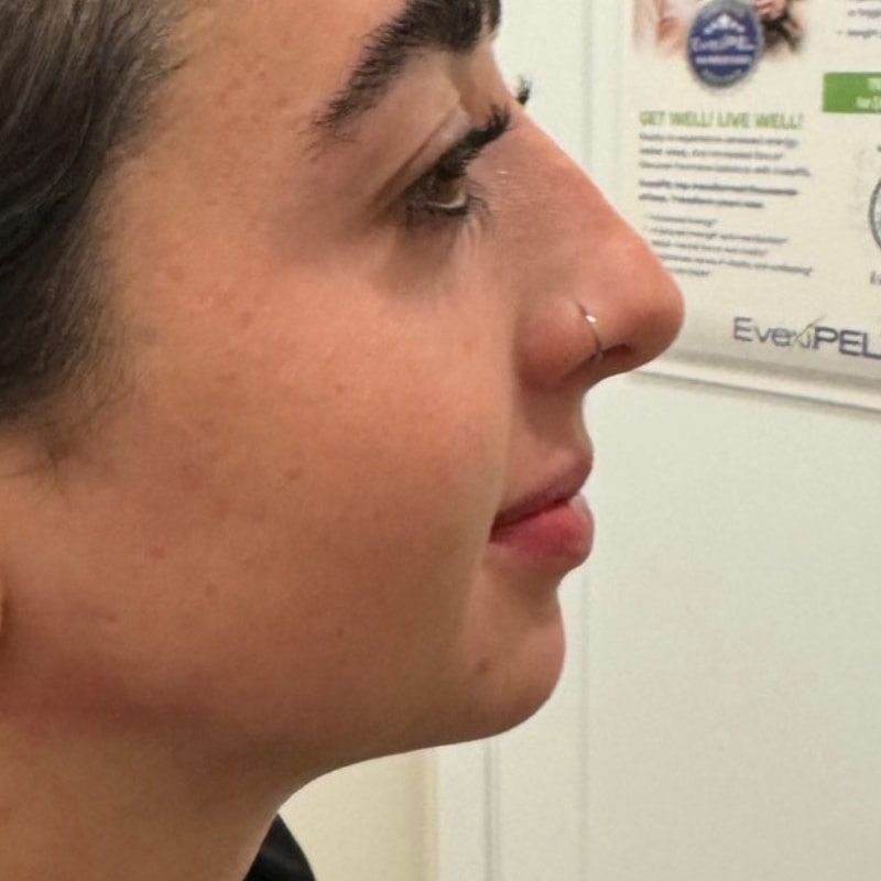 A result from Summit Medical Spa