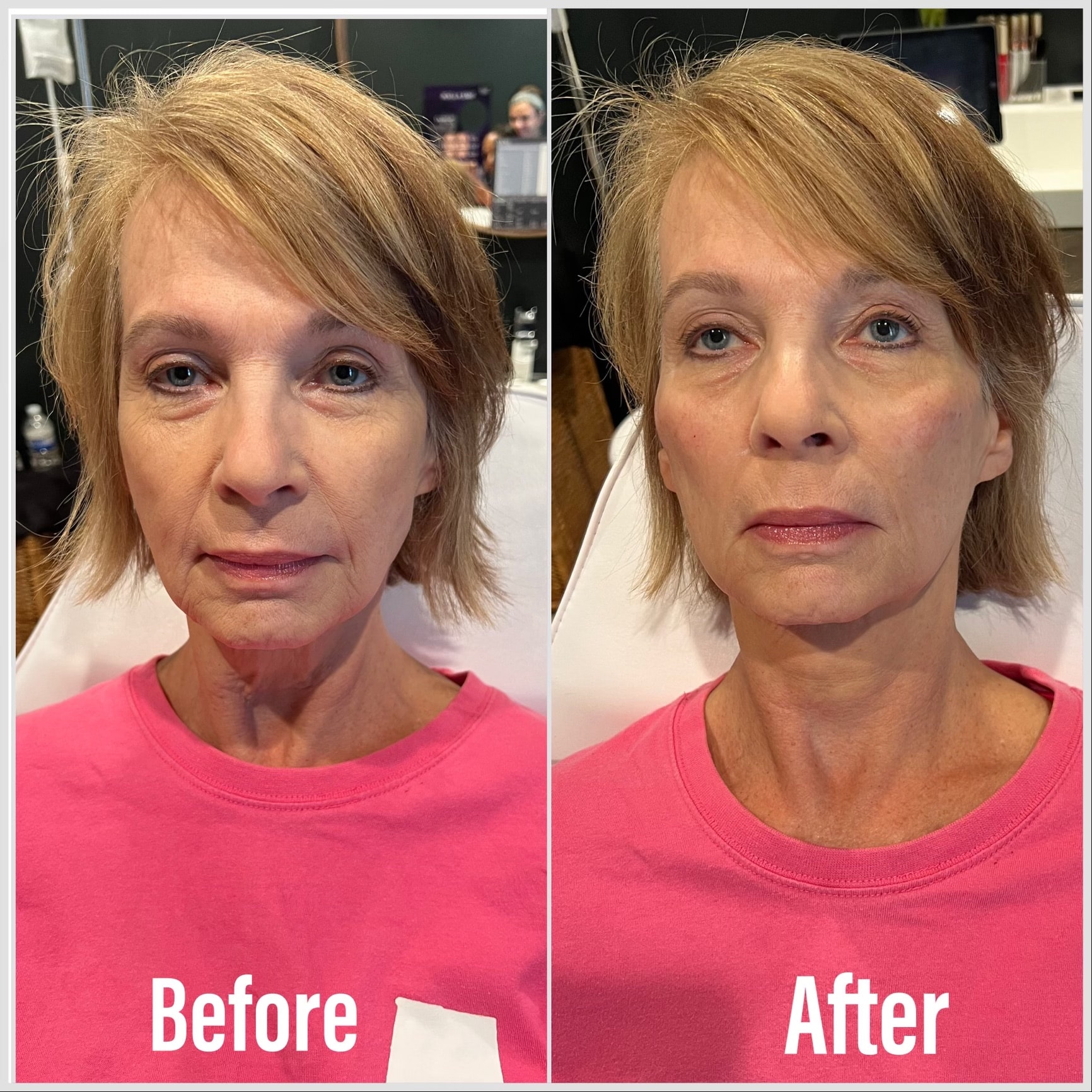 A result from Summit Medical Spa