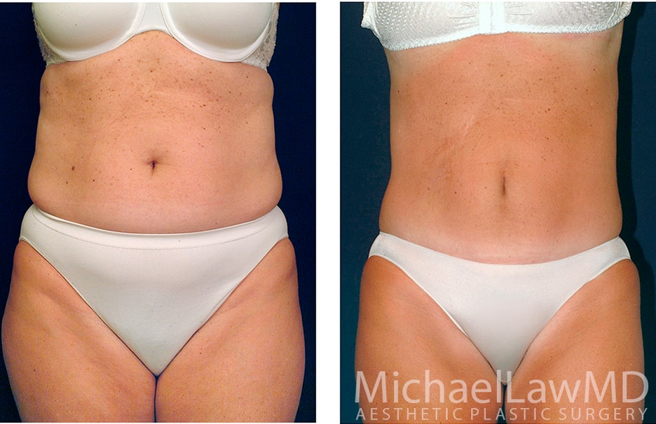 A result from Michael Law MD Aesthetic Plastic Surgery