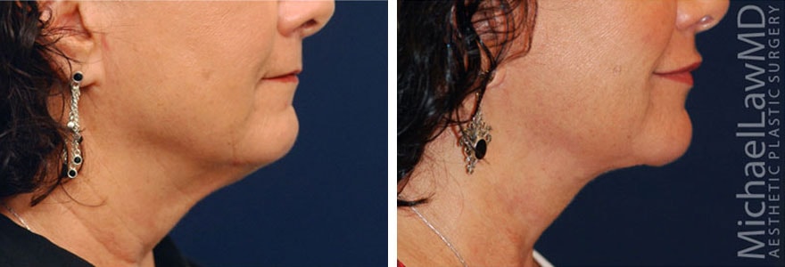 A result from Michael Law MD Aesthetic Plastic Surgery