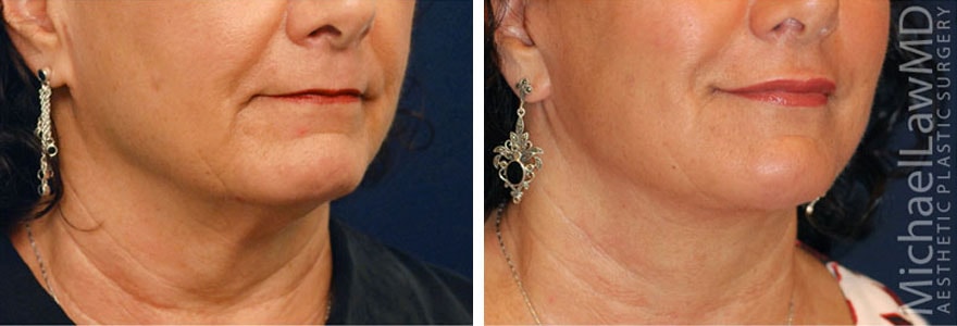 A result from Michael Law MD Aesthetic Plastic Surgery