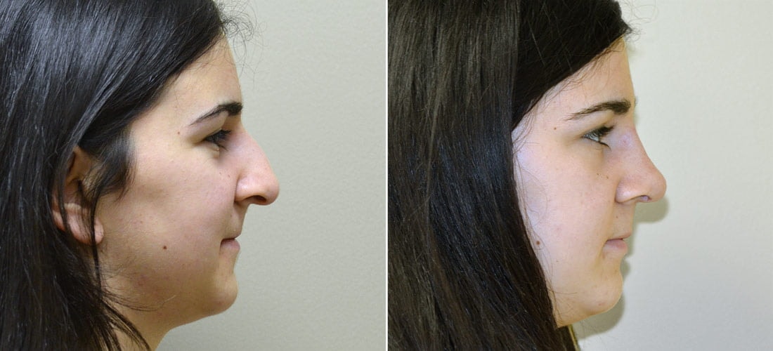 A result from Anderson Sobel Cosmetic Surgery