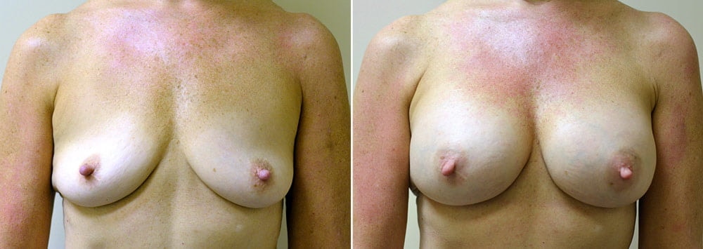 A result from Anderson Sobel Cosmetic Surgery