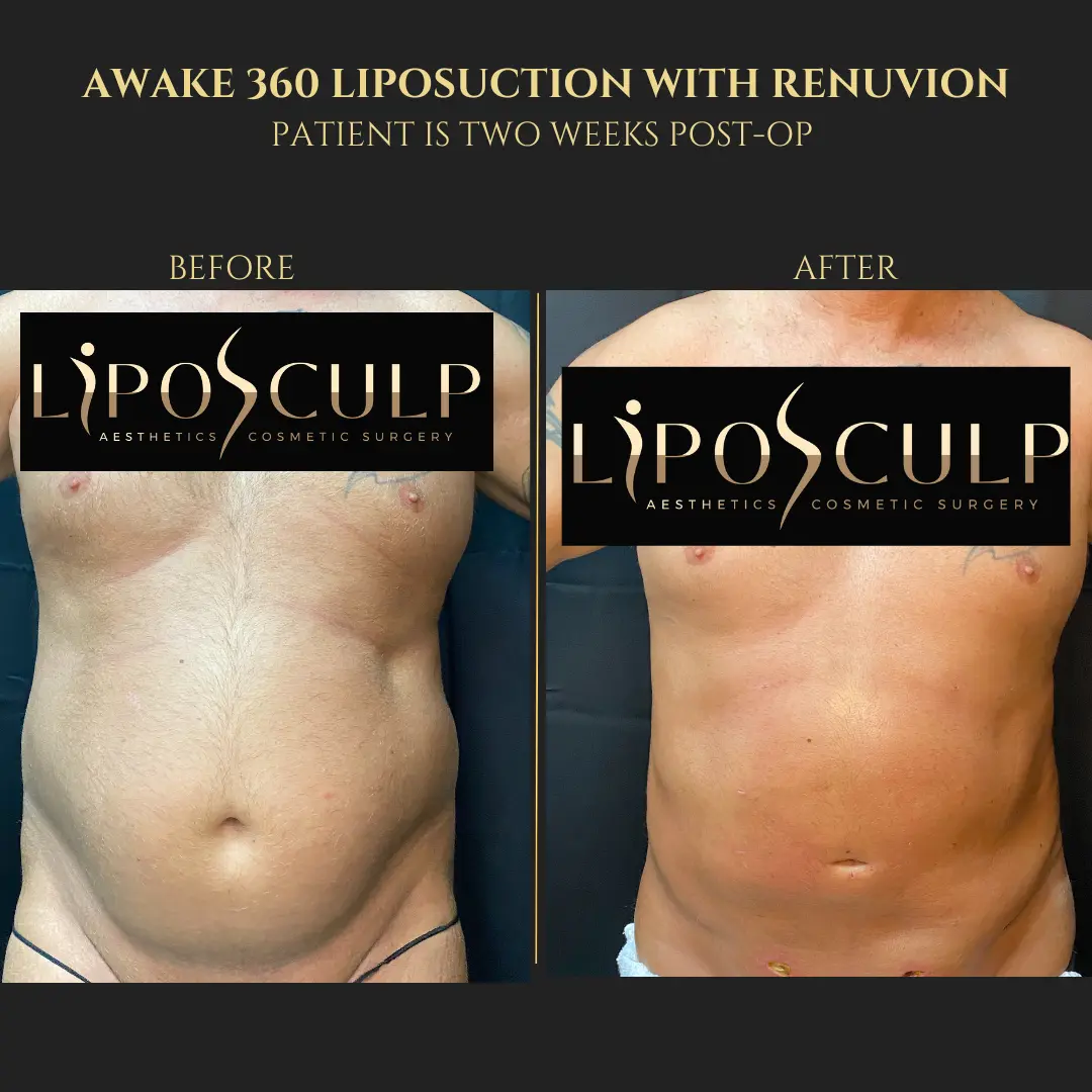 Procedure result at LipoSculp