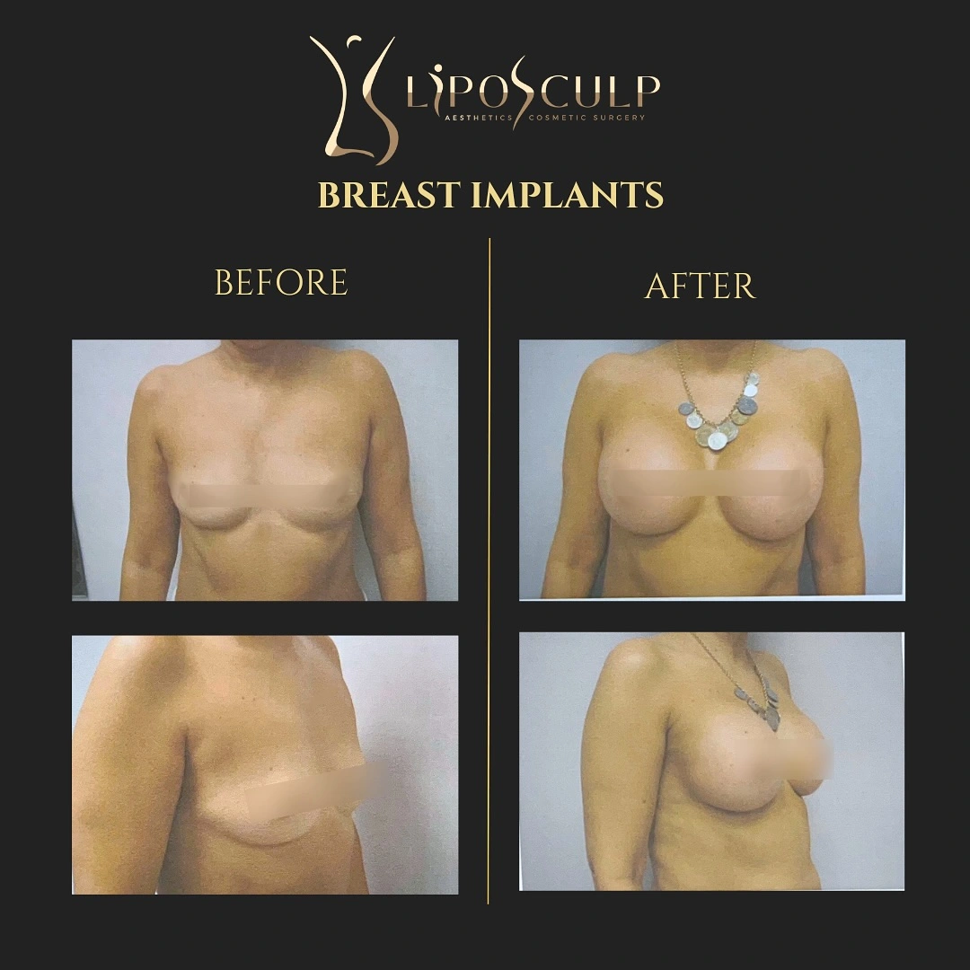 Procedure result at LipoSculp