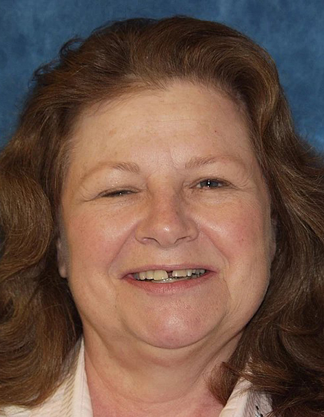 Dental Designs of Bountiful veneers result — Bountiful, UT