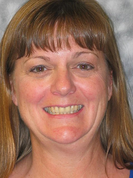 Dental Designs of Bountiful veneers result — Bountiful, UT