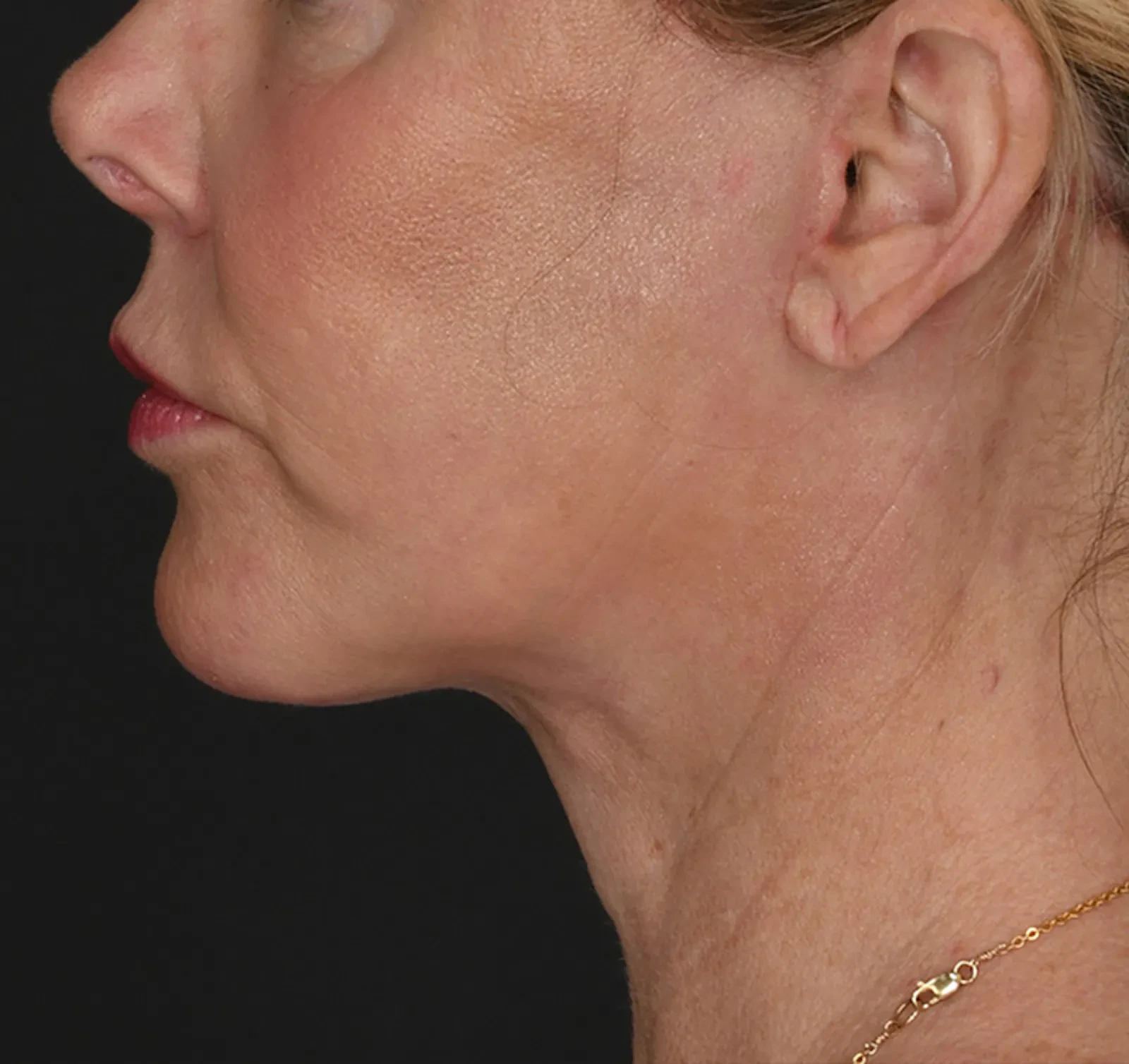 A result from Meade Aesthetic Surgery