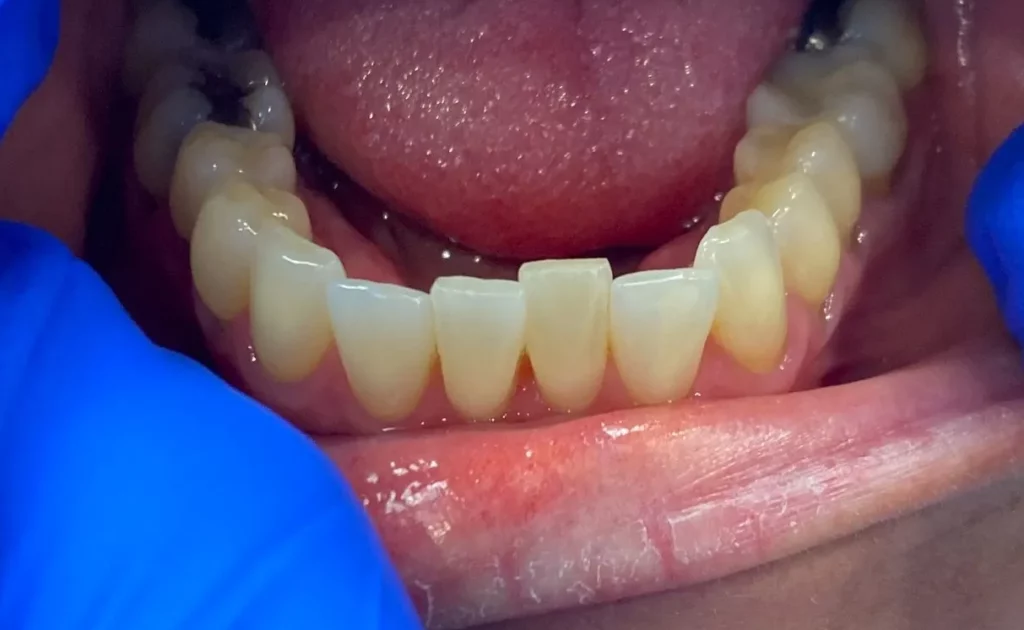 Smile Makeover