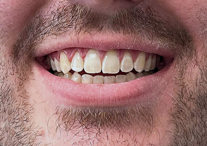 Smile Makeover