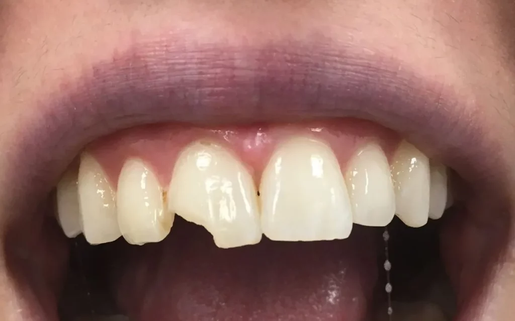 Smile Makeover