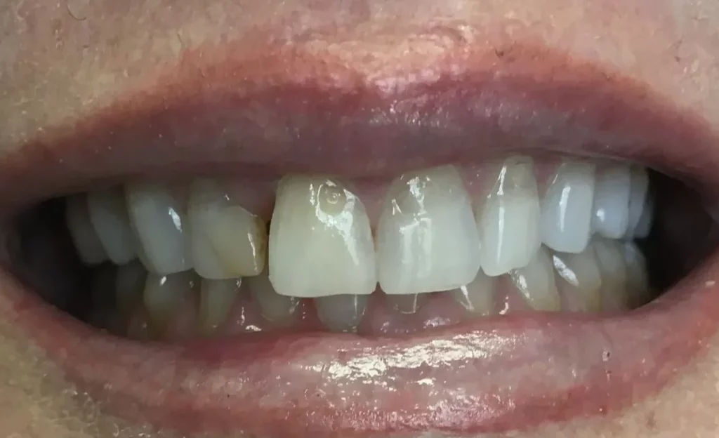 Smile Makeover
