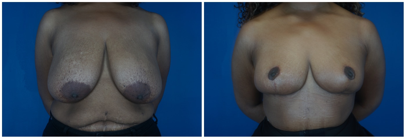 A result from Dr. Ashley Steinberg - Trouvaille Aesthetics & Plastic Surgery