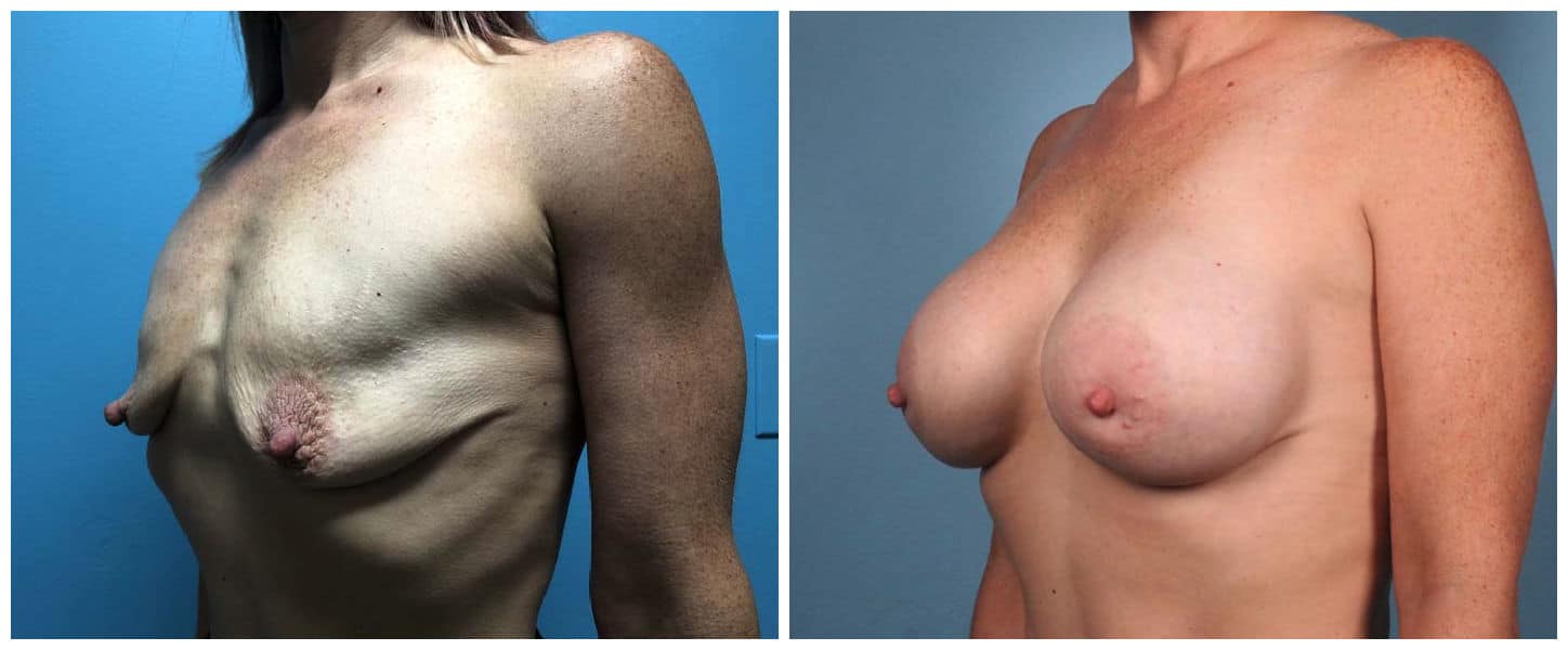 A result from Dr. Ashley Steinberg - Trouvaille Aesthetics & Plastic Surgery