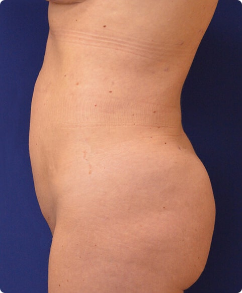 A result from Advanced Plastic Surgery