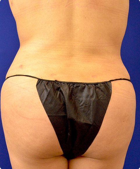 A result from Advanced Plastic Surgery