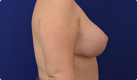 A result from Advanced Plastic Surgery