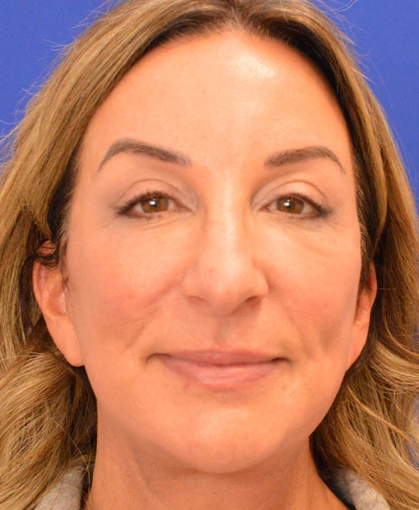 A result from Advanced Plastic Surgery