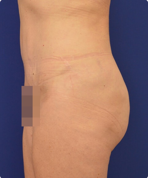 A result from Advanced Plastic Surgery