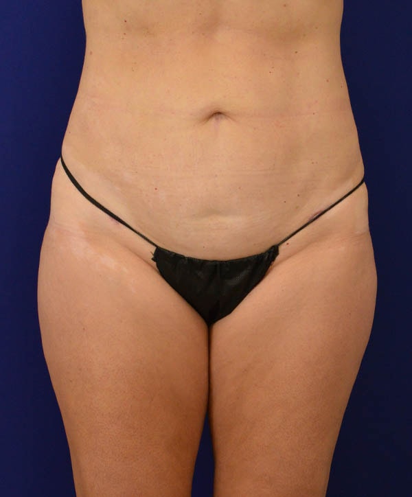 A result from Advanced Plastic Surgery