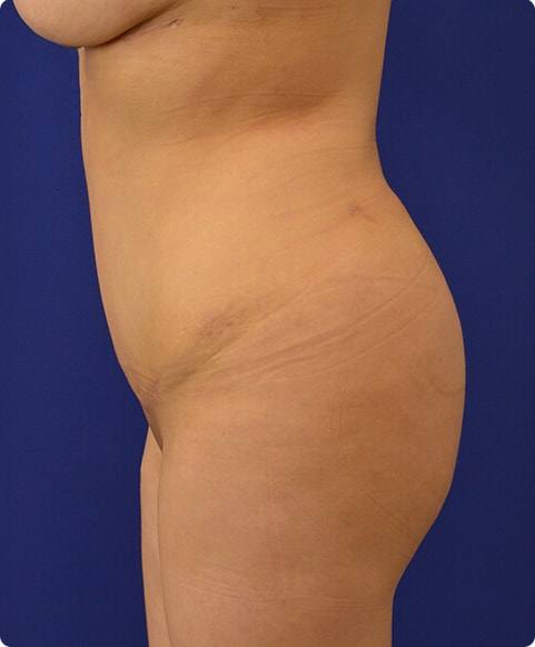A result from Advanced Plastic Surgery