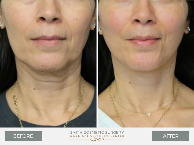 A result from Smith Cosmetic Surgery