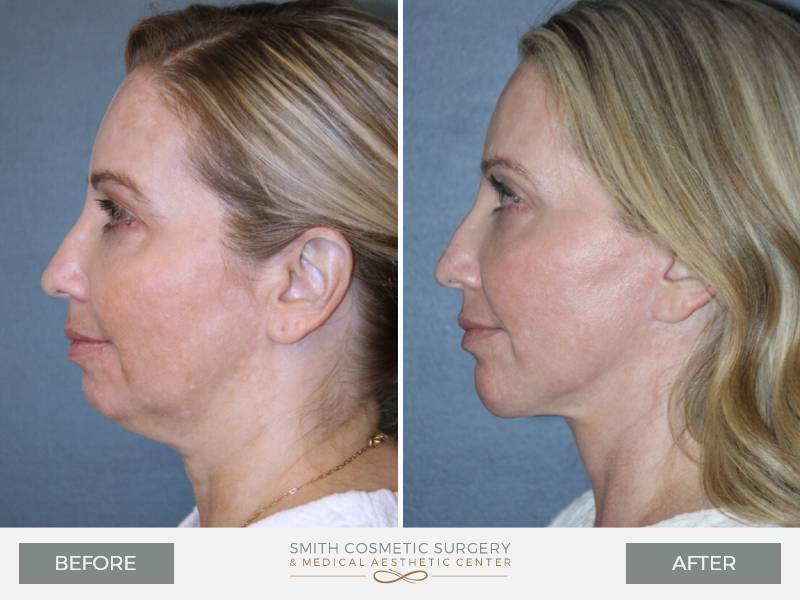 A result from Smith Cosmetic Surgery