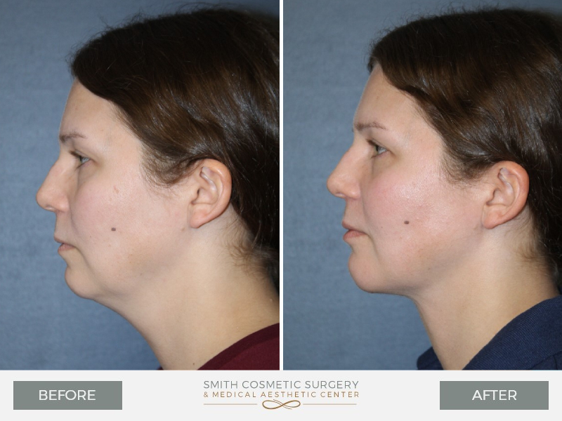 A result from Smith Cosmetic Surgery
