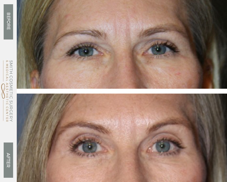 A result from Smith Cosmetic Surgery
