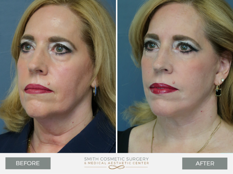 A result from Smith Cosmetic Surgery