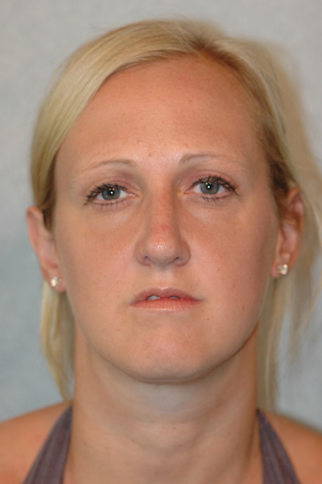 A result from Chegar Facial Plastic Surgery