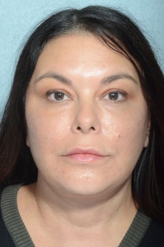 A result from Chegar Facial Plastic Surgery