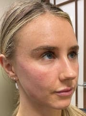 A result from Avalon Laser | Carlsbad Botox Clinic and Medical Spa