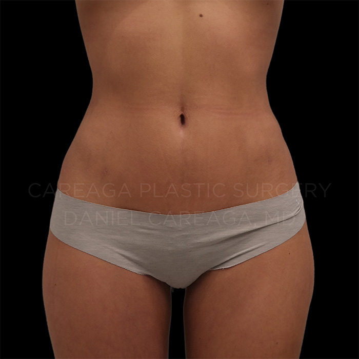 Liposuction result at Careaga Plastic Surgery