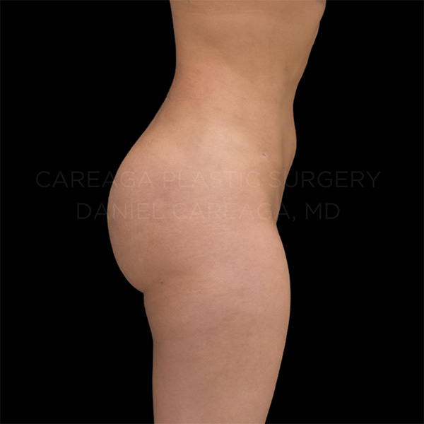 Bbl result at Careaga Plastic Surgery